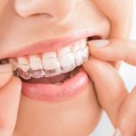 Invisalign for Teens in Bowling Green