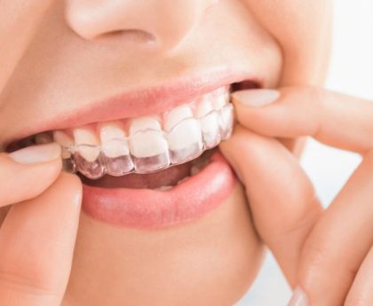 Invisalign for Teens in Bowling Green