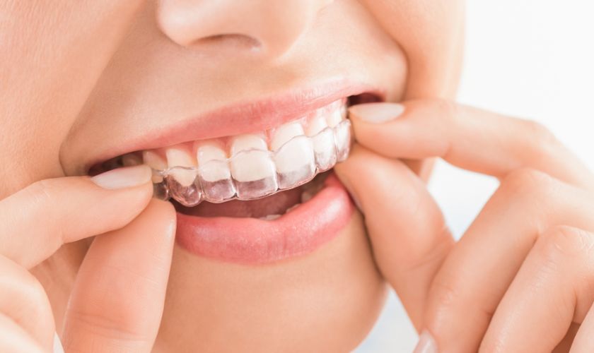Invisalign for Teens in Bowling Green