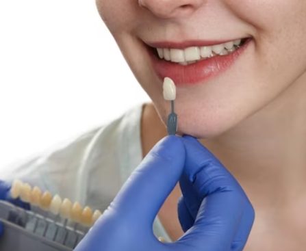 Are Dental Veneers Right for You - A Candid Look at Candidacy - Miel Dental Aesthetics Peabody - Peabody Dentist