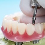 Dental Implant Types