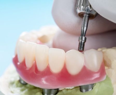 Dental Implant Types