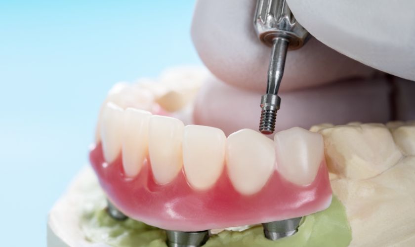 Dental Implant Types