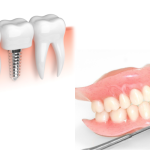 Dental Implants vs. Dentures - living well dental Naperville