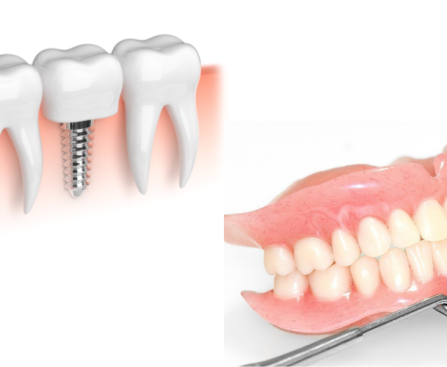 Dental Implants vs. Dentures - living well dental Naperville