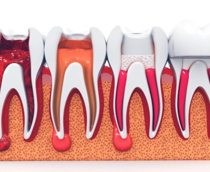 Root Canal Treatment- The Smile Shapers Dentist Ventura