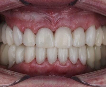 Complete Smile Restoration- Valley Smiles Phoenix Dentist