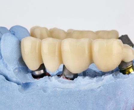 Dental Bridges- The Smile Shapers Dentist Ventura