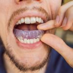 Night Guards-The Smile Shapers Dentist Ventura