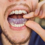 Sports Mouth Guard- Havertown Dental Arts