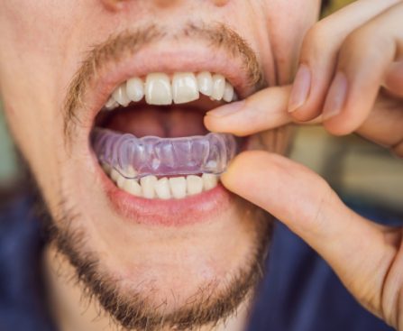 Sports Mouth Guard- Havertown Dental Arts