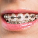 Traditional Braces- Dentistry Of Uptown Charlotte