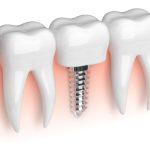 Value of Dental Implants