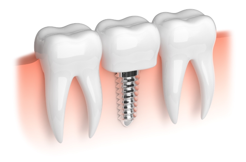 Value of Dental Implants