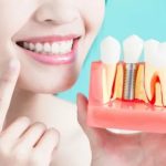 Dental-implants Look Amazing In 9 Days