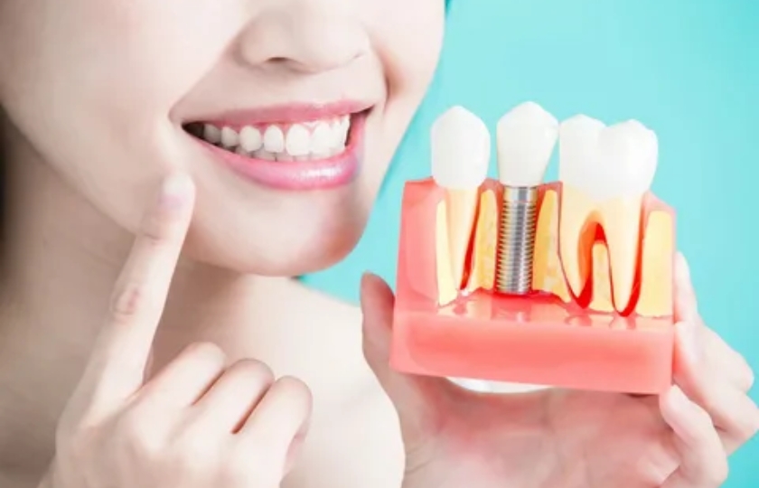 Dental-implants Look Amazing In 9 Days