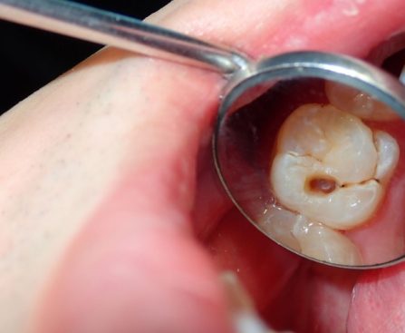 Dental Cavity-The Smile Shapers Dentist Ventura