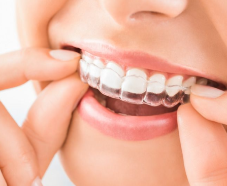 The Ultimate Guide to Clear Aligners How They Work and What to Expect