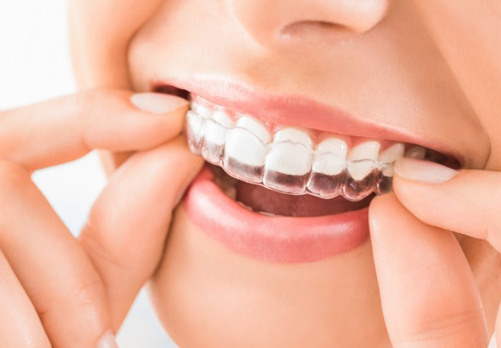 The Ultimate Guide to Clear Aligners How They Work and What to Expect